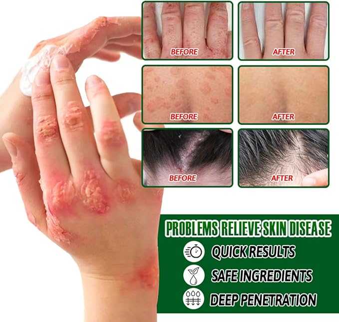 Psoriasis Cream 20g | Soothing & Hydrating Skin Relief Formula – 100% Original