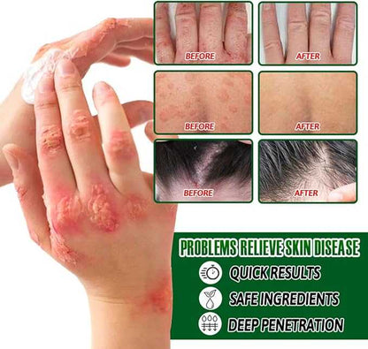 Psoriasis Cream 20g | Soothing & Hydrating Skin Relief Formula – 100% Original