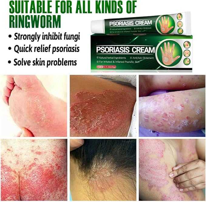 Psoriasis Cream 20g | Soothing & Hydrating Skin Relief Formula – 100% Original